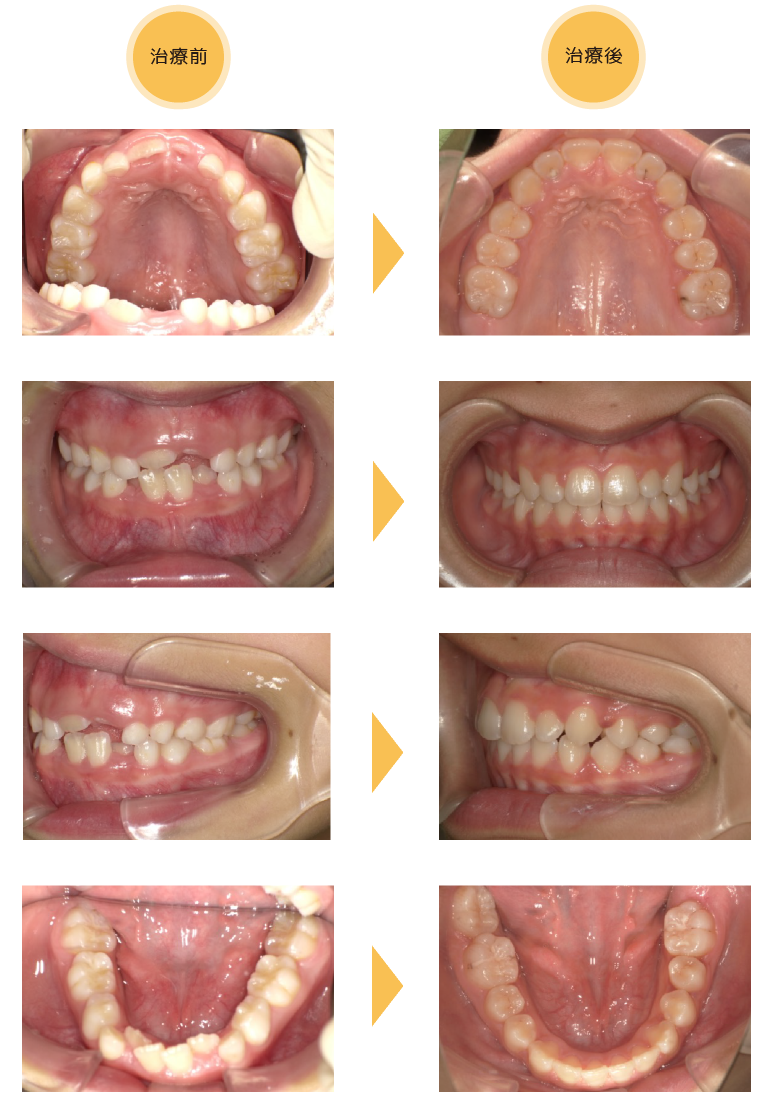 熊本県熊本市中央区の歯科医院-ひかる歯科ちえこども歯科の治療実績6-1