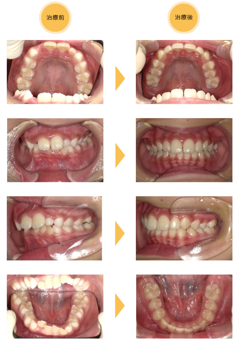 熊本県熊本市中央区の歯科医院-ひかる歯科ちえこども歯科の治療実績6-1