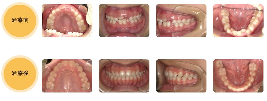 熊本県熊本市中央区の歯科医院-ひかる歯科ちえこども歯科の治療実績6