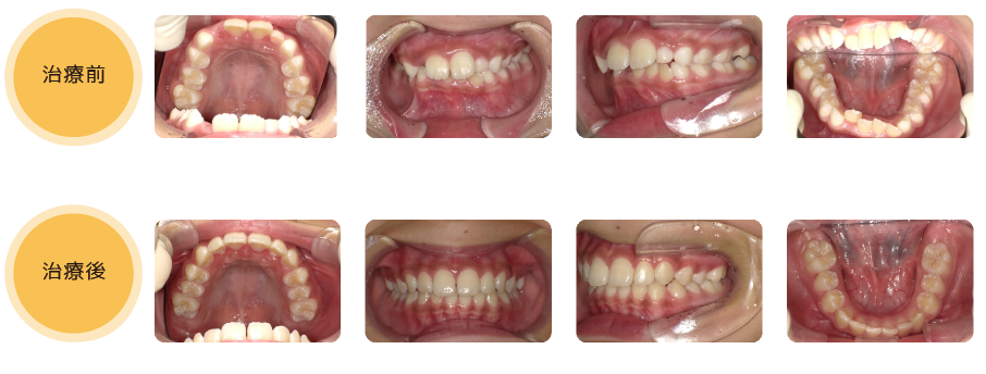 熊本県熊本市中央区の歯科医院-ひかる歯科ちえこども歯科の治療実績6