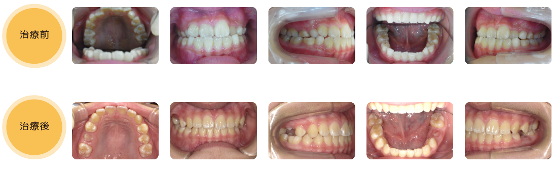 熊本県熊本市中央区の歯科医院-ひかる歯科ちえこども歯科の治療実績6