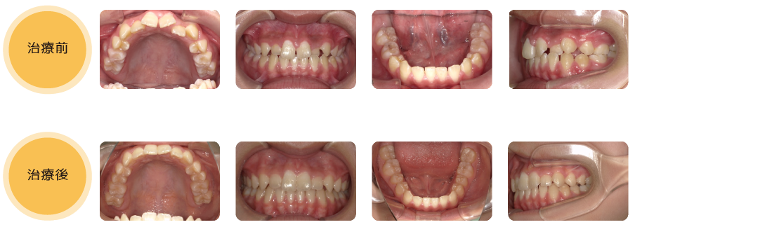 熊本県熊本市中央区の歯科医院-ひかる歯科ちえこども歯科の治療実績6