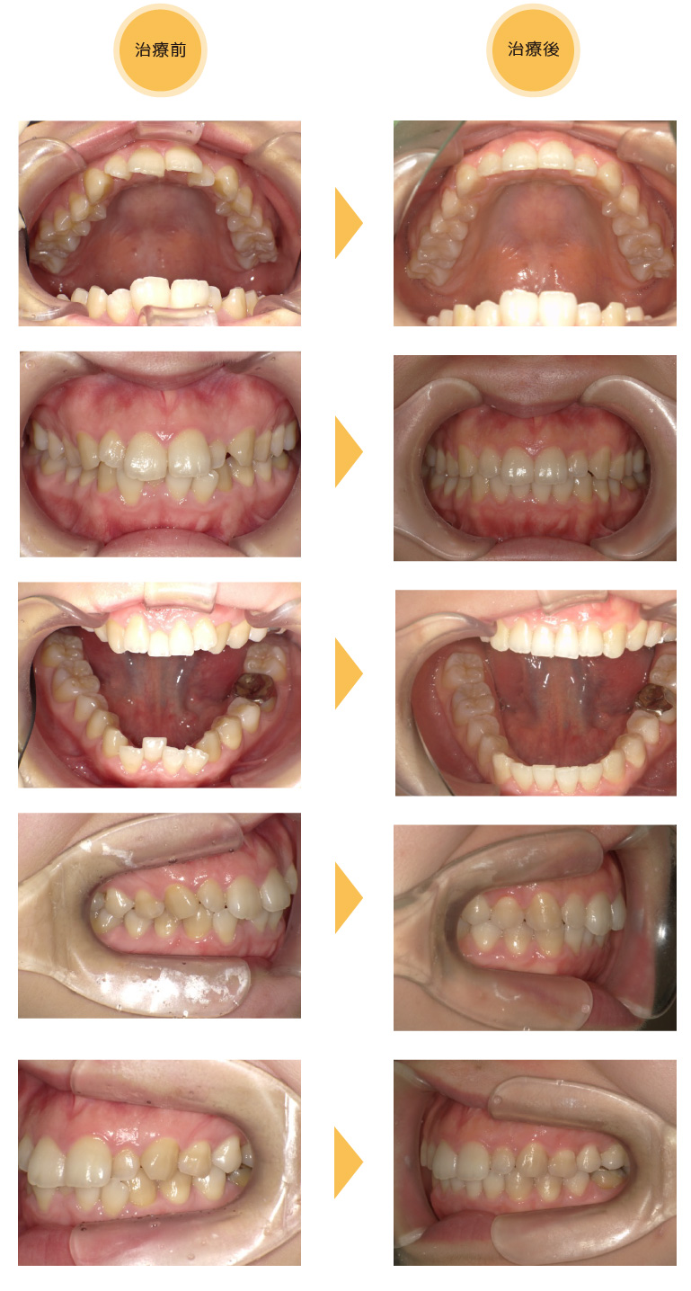 熊本県熊本市中央区の歯科医院-ひかる歯科ちえこども歯科の治療実績3-1